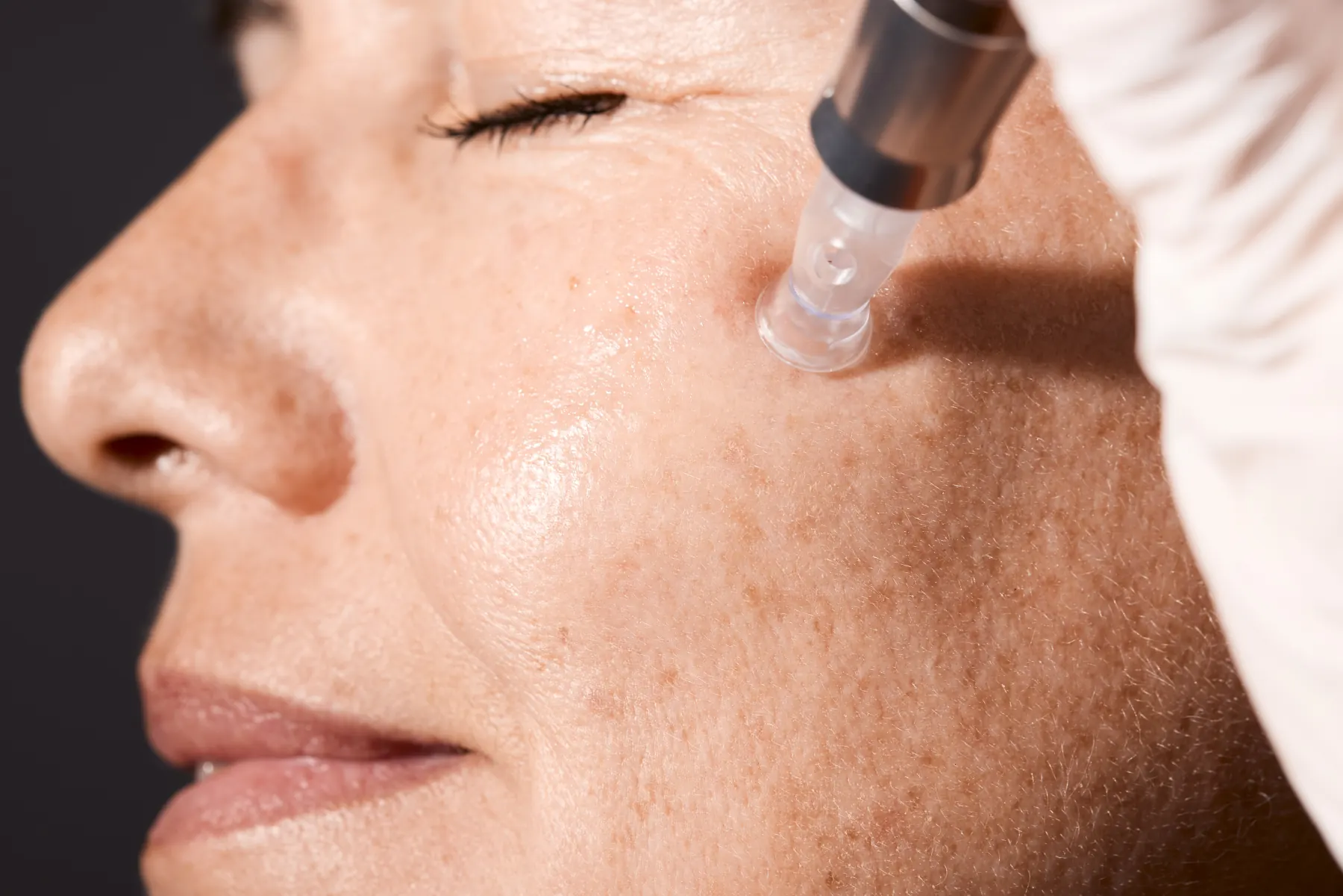 Derma SR Dermaneedling Detail